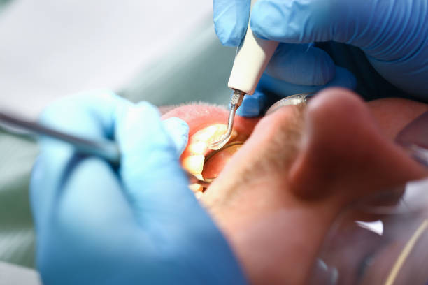 Emergency Dental Filling Replacement in OK
